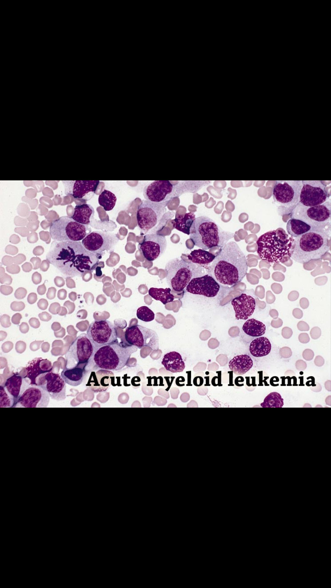 What are the signs of end stage acute myelogenous leukemia?